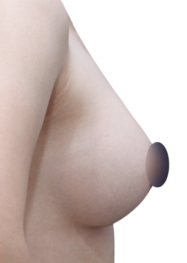 가슴재수술, 실패를 줄이기 위한 기준은? 관련 이미지 7