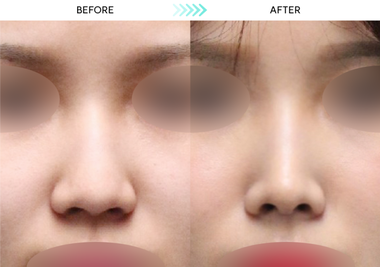 [First Rhinoplasty] Month 2 of Hump Nose Correction: The Standard for Implant-Free Hump Nose Correction image 3