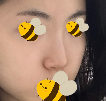 [강남성형외과 매부리코성형 후기] 보기 싫었던 매부리코,, 자려한 인생 코라인 찾아 고민 해결했어요! 관련 이미지 4