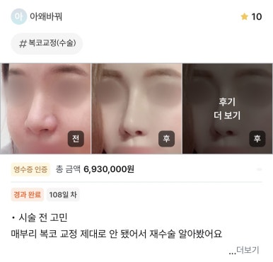 [강남역성형외과 매부리코성형 후기] 첫 수술 실패한 복코 매부리코.. 재수술로 완벽하게 성공했어요! 관련 이미지 1