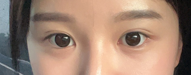 눈성형 개인별 맞춤 수술 방법 관련 이미지 1