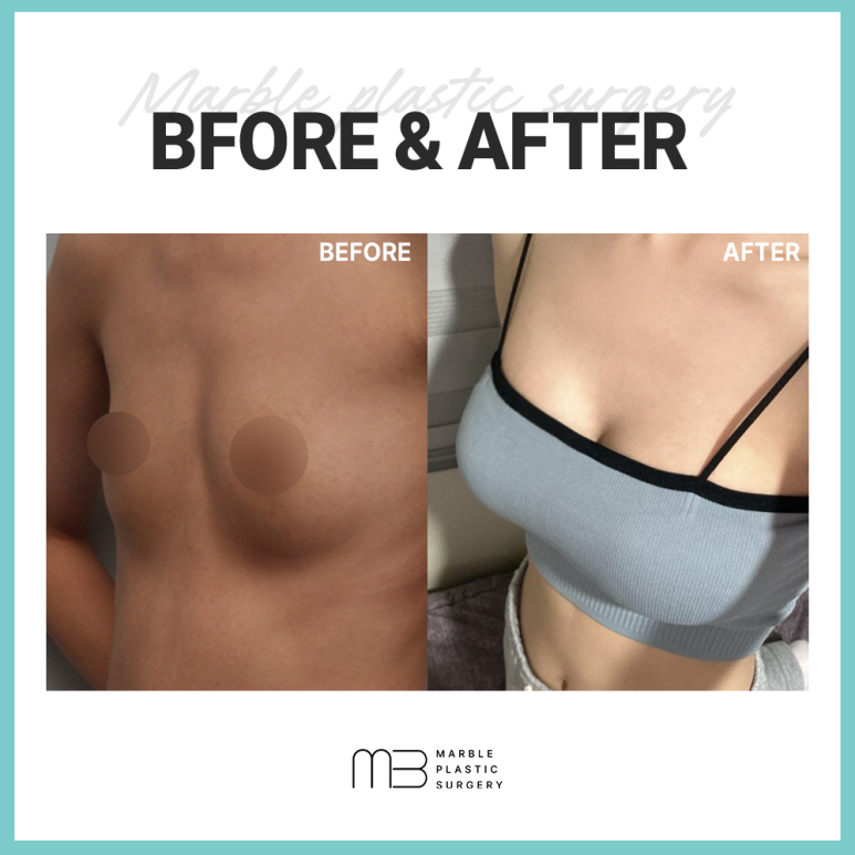 가슴 보형물, 모양 촉감 차이 왜 이렇게 다를까요? 관련 이미지 2