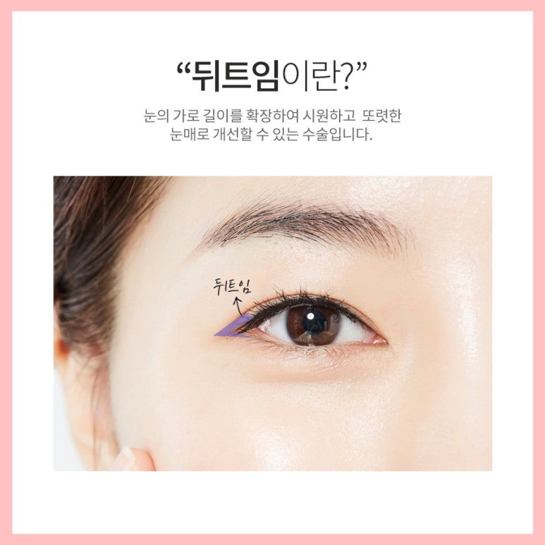 눈밑트임 부드러운 이미지로! 마블성형외과의원 관련 이미지 5