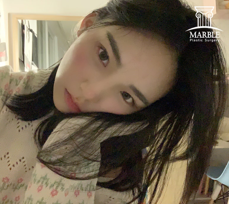눈수술(눈성형) 후, 알아두면 좋은 주의사항 정리! 관련 이미지 4
