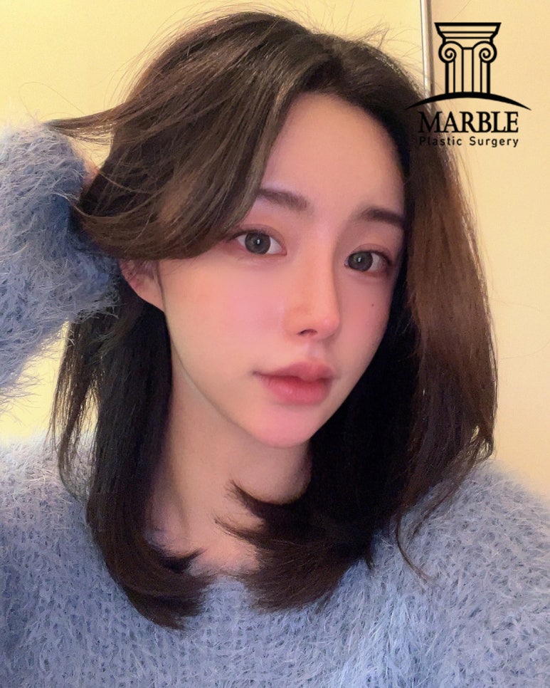 눈수술(눈성형) 후, 알아두면 좋은 주의사항 정리! 관련 이미지 3