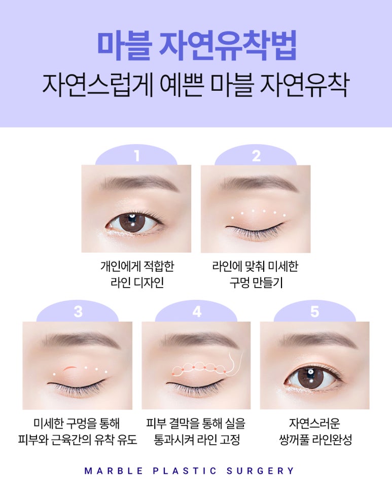방학동안 회복 끝내는 쌍수 후 관리법 관련 이미지 2