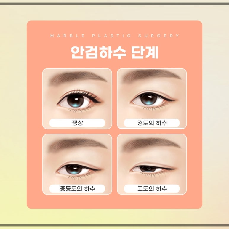 눈매교정 수술, 나도 필요한가? 관련 이미지 4