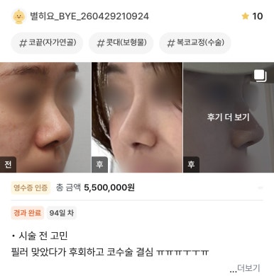[Gangnam Plastic Surgery Bulbous Nose Surgery Review] I Was Stressed About My Nose Filler Spreading... but the Natural-Looking Straight-Line Profile Was a Huge Success! Haha image 1