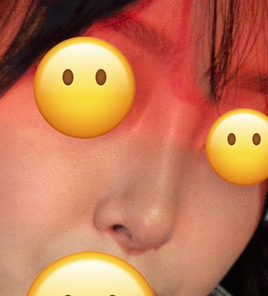 [Bulbous Nose Surgery Review] Solved My Plain Bulbous Nose Concerns! I Got a More Defined Nasal Bridge and a Better Impression! image 4