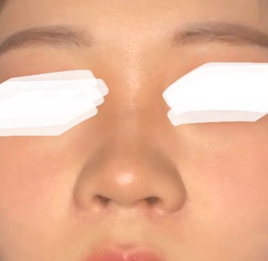 [마블성형외과 코수술 후기] 퍼진 복코에 매부리까지.. 인상 강해 보여서 거울 보기 싫었던 과거 탈출ㅠㅠ 관련 이미지 3