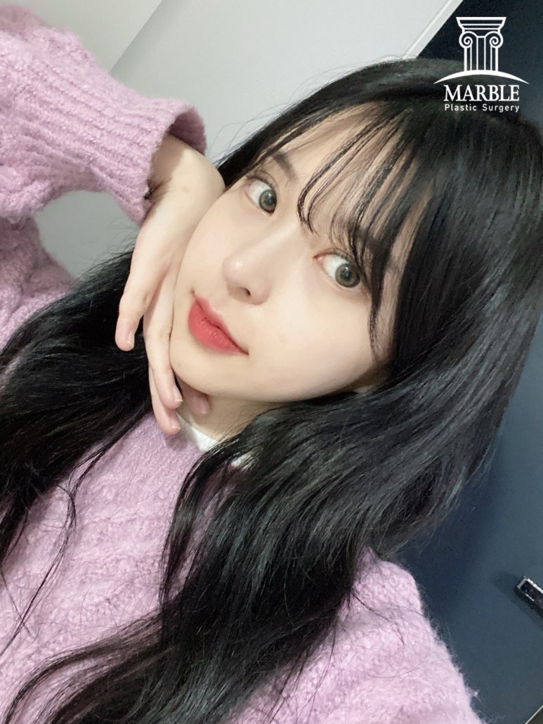 더 이상 쌍꺼풀재수술은 그만, 내 눈은 왜 잘 풀릴까? 관련 이미지 4