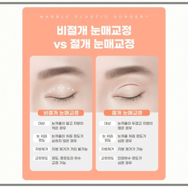 눈매교정 수술, 나도 필요한가? 관련 이미지 8