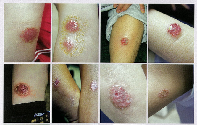 동전모양습진, 화폐상습진(Nummular eczema) 알아보기 관련 이미지 3