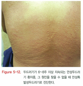 다양한 두드러기 종류 1탄 (알레르기성/ 만성특발성/ 한랭성/ 열성/ 피부묘기증 등) 관련 이미지 9