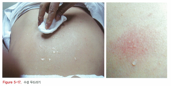 다양한 두드러기 종류 2탄 (진동성, 콜린성, 접촉성, 압박성, 아스피린 불내성, 햇빛 두드러기, 물 두드러기 등) 관련 이미지 12