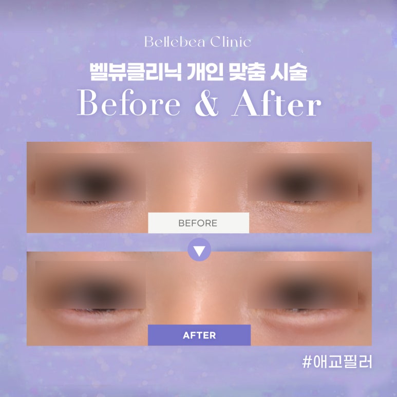 강남역피부과 애교필러전후사진 애교필러후기 관련 이미지 1