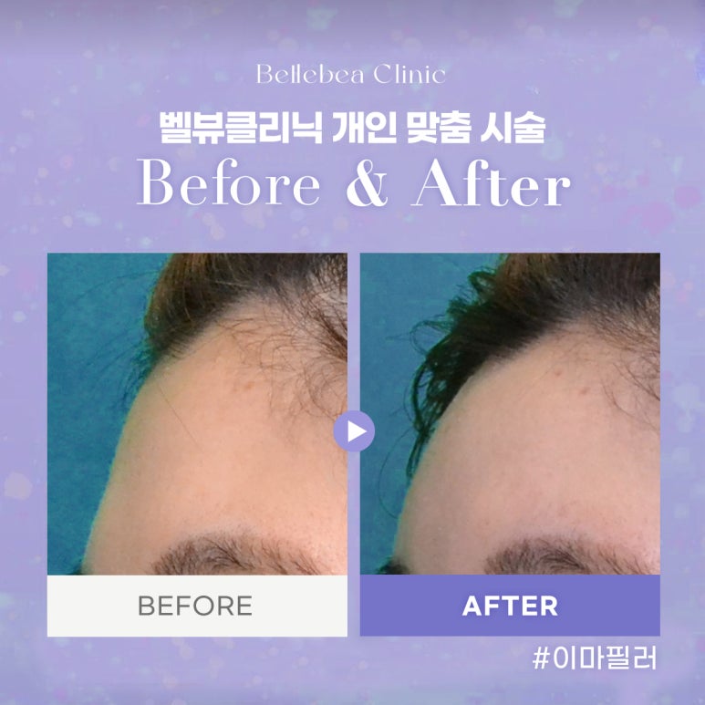31. 벨뷰클리닉 이마필러 전후사진 관련 이미지 1