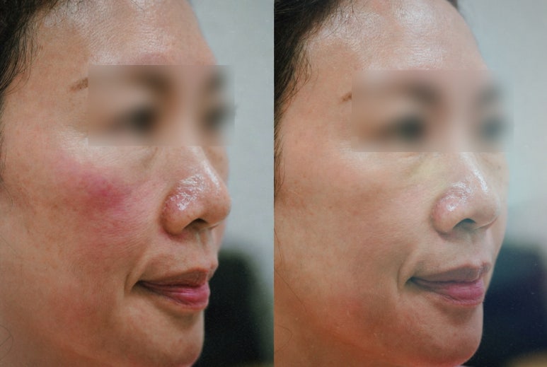 채우기만 하는 필러는 잊으세요. 이제는 콜라겐을 직접 깨울 시간입니다 관련 이미지 3