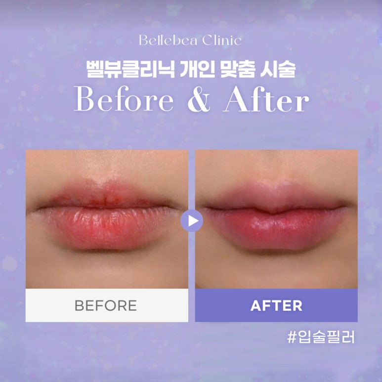37. 벨뷰클리닉 입술필러 전후사진 관련 이미지 1