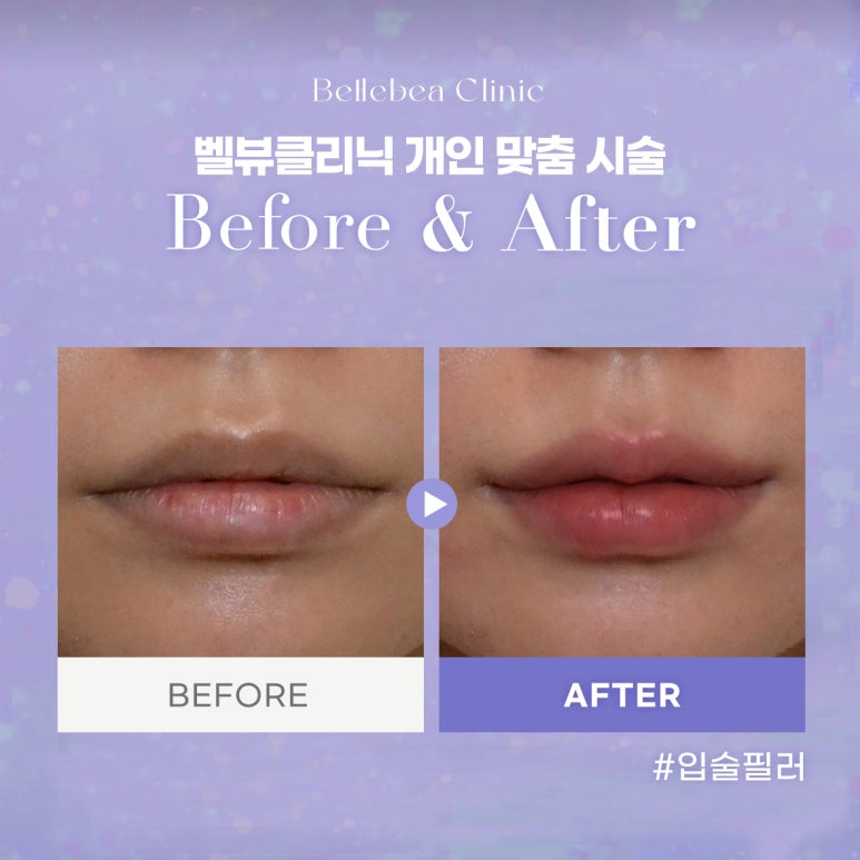49. Bellevue Clinic Lip Filler Before-and-After Photos image 1
