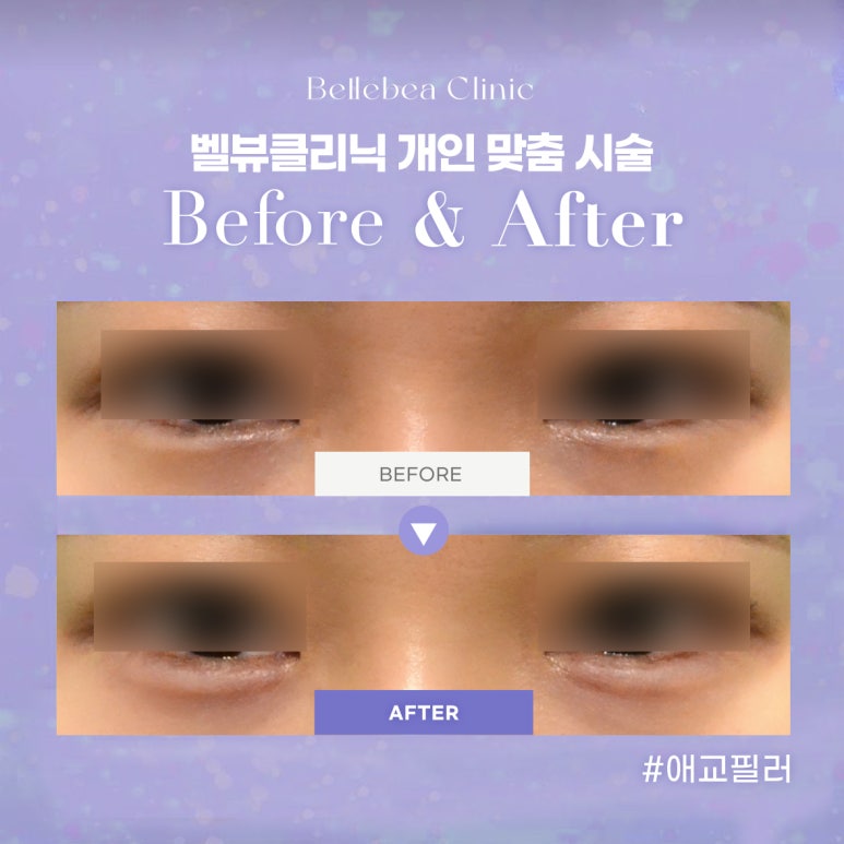 22. 강남역피부과 애교필러전후사진 애교필러후기 관련 이미지 1