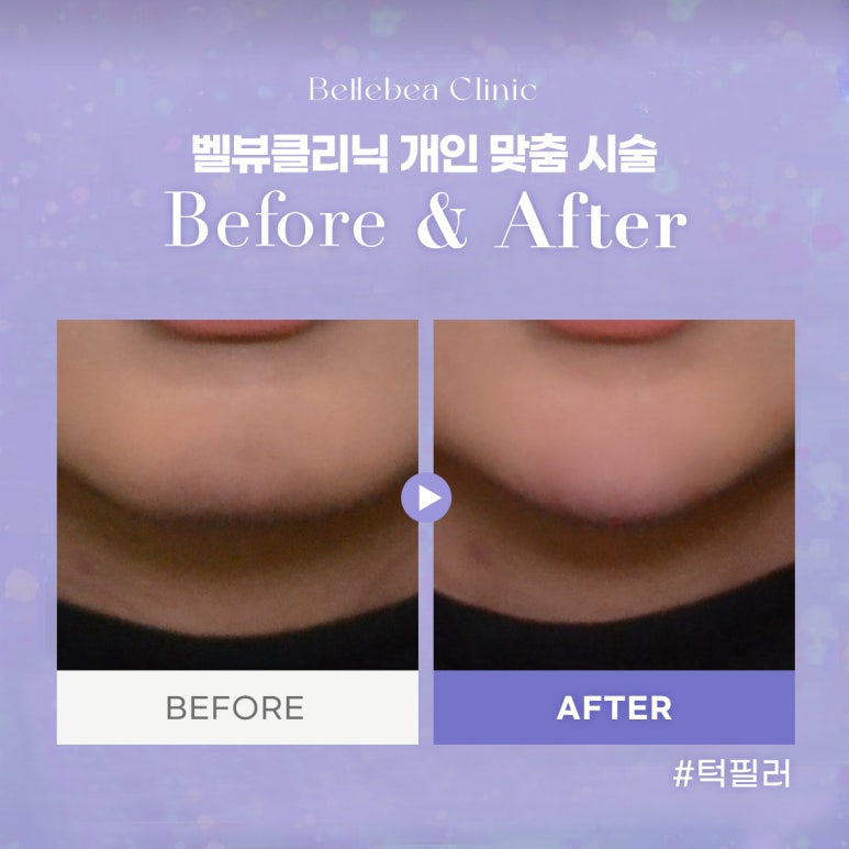7. 강남역피부과 무턱필러전후사진 무턱필러후기 관련 이미지 1