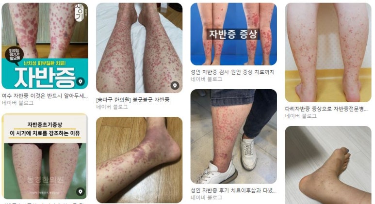 피부과 시술 후 멍이 심하게 들었다? 나는 왜 멍이 잘 들까? 관련 이미지 3