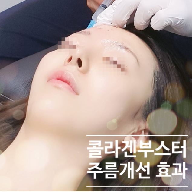[닥터벨뷰 칼럼 58.] 확실하고 자연스럽게 피부 콜라겐을 채우는 방법 (4)쥬베룩 볼륨 관련 이미지 9