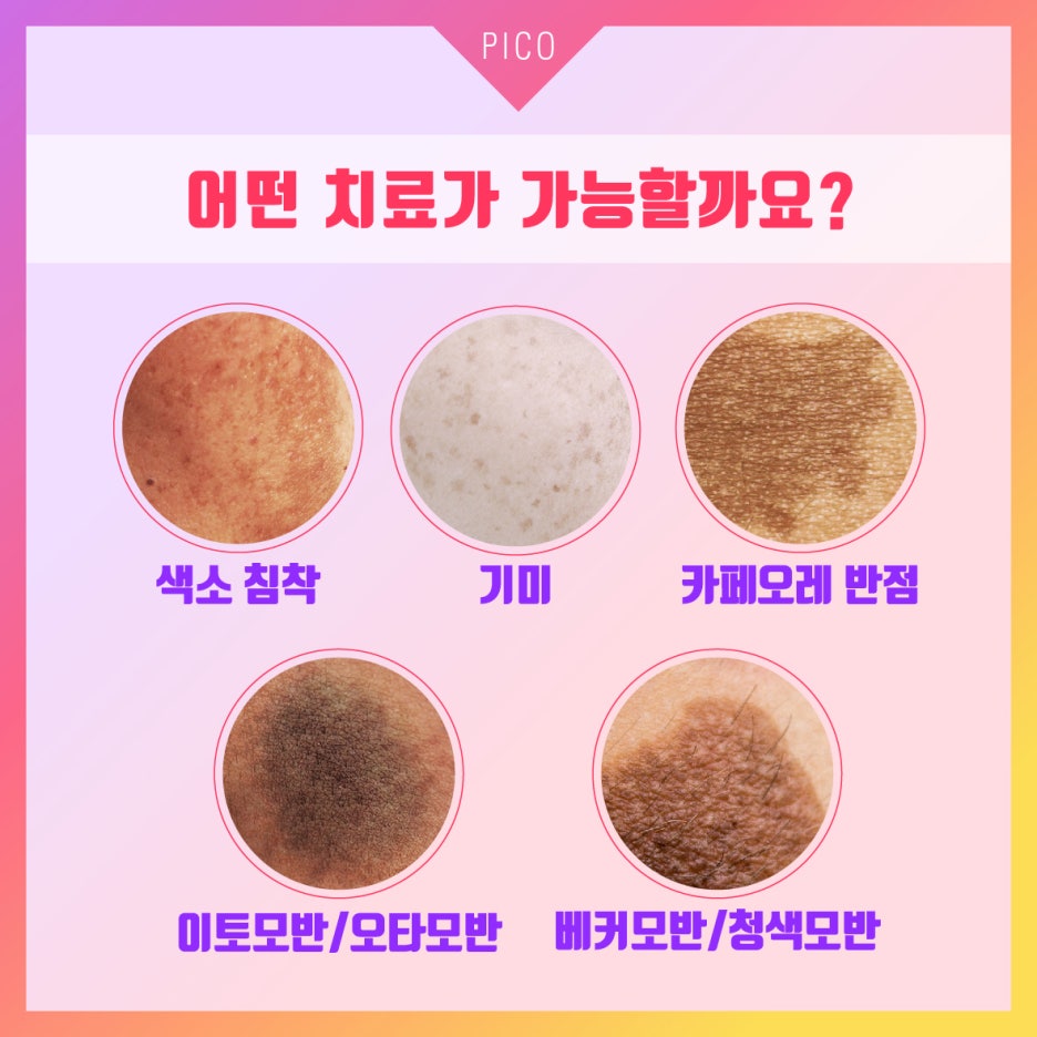 반영구눈썹문신 제거는 피코 레이저! 기미, 모공, 흉터 개선 효과까지 관련 이미지 10