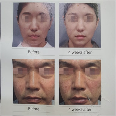 [Dr. Bellview Column 90.] Luxury Skin Completed by a Hair’s Breadth of Difference: Why the Dosage of Skin Boosters Determines the Details of the Result image 4