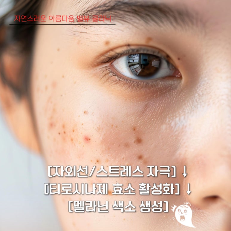 기미&middot;잡티 등 색소 치료에 번번이 실패하는 진짜 이유 관련 이미지 5