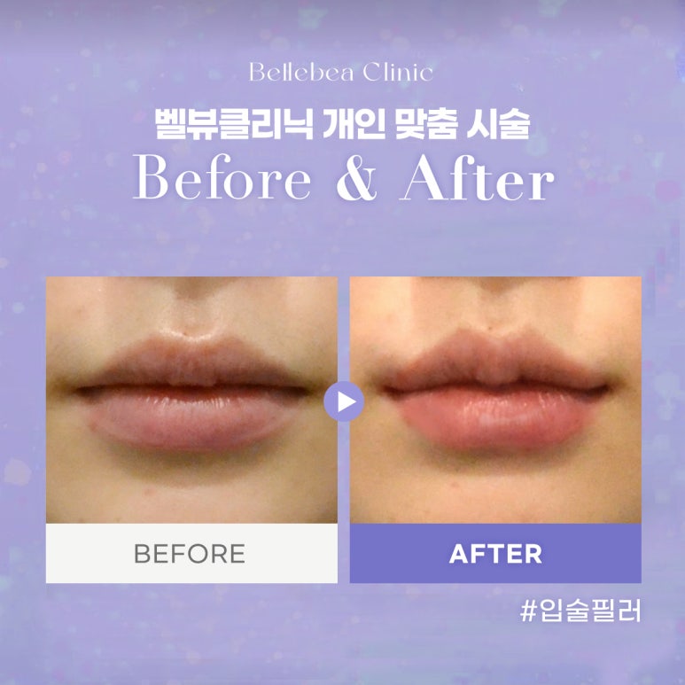 9. 강남역피부과 입술필러전후사진 입술필러후기 관련 이미지 1
