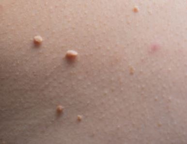 [Dr. Belleview Column 74.] Why You Shouldn’t Leave Skin Tags on Your Neck Alone image 4