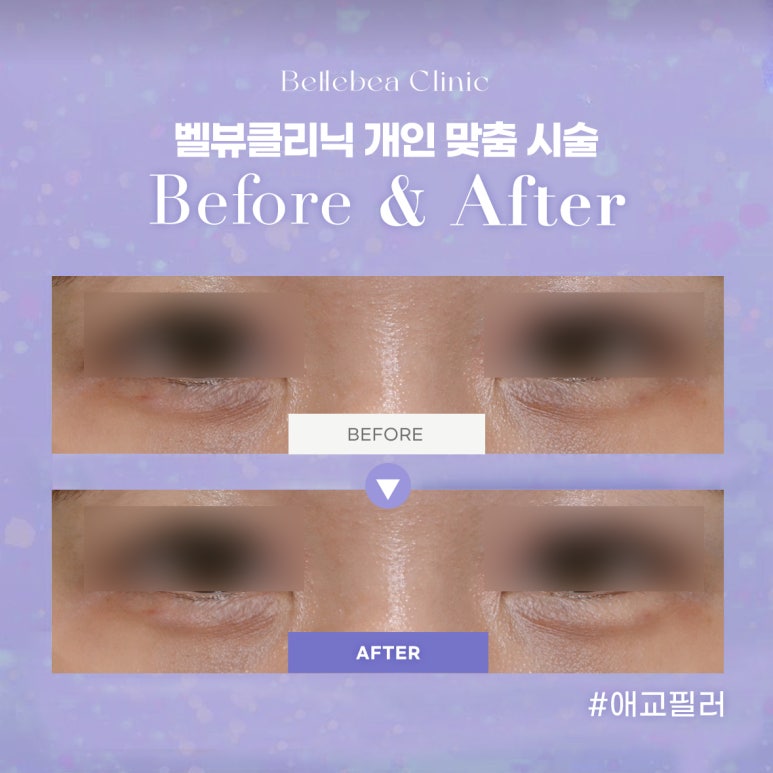 41. 벨뷰클리닉 애교필러 전후사진 관련 이미지 1