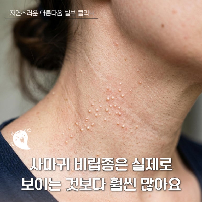 올 여름 고민되는 점, 사마귀, 비립종 제거 싹! 관련 이미지 3