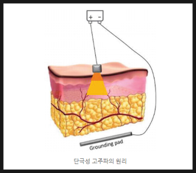 [닥터벨뷰 칼럼 86.]울쎄라(HIFU), 써마지(RF), 그리고 벨뷰에 새로 도입된 온다 리프팅 비교 관련 이미지 5