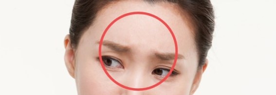 미간 보톡스 효과와 부작용(안검하수, 사무라이 눈썹, 쌍꺼풀과 애교 사라짐 등) 관련 이미지 3