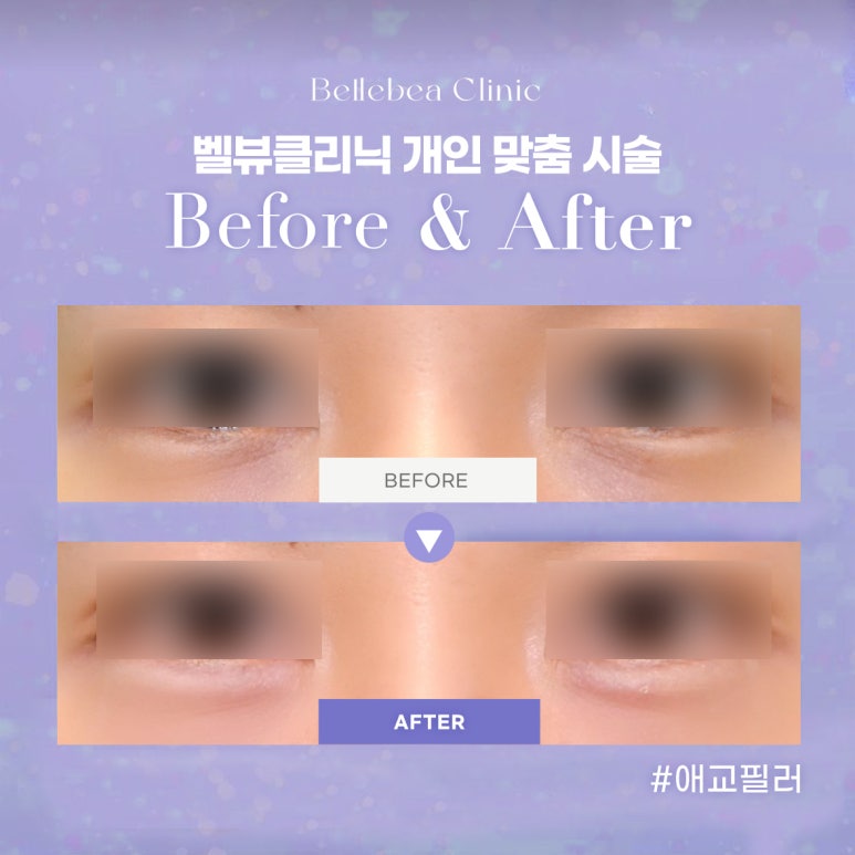 30. 벨뷰클리닉 애교필러 전후사진 관련 이미지 1