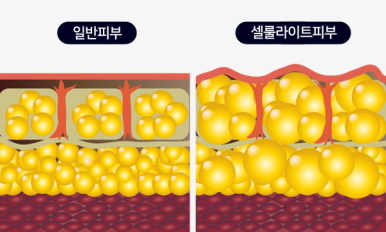 똘똘 뭉친 셀룰라이트로 고민해보셨나요? (feat. 노블쉐이프) 피부과에서 편하게 받는 셀룰라이트 치료 관련 이미지 4
