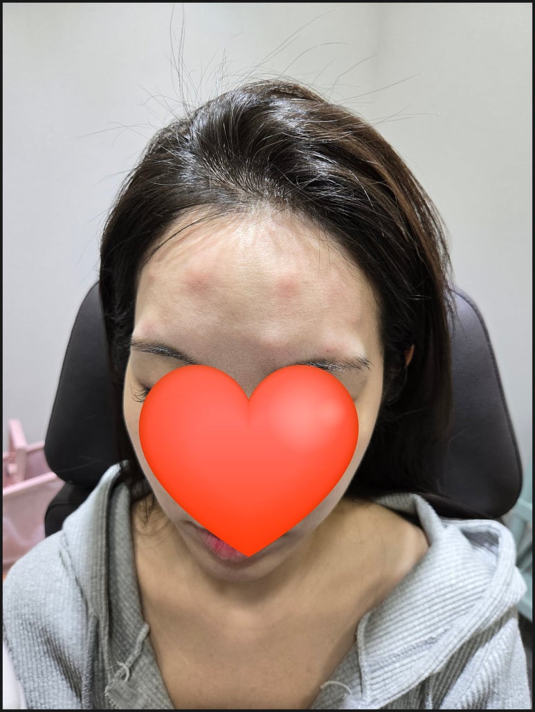 [닥터벨뷰 칼럼 101.] 보톡스 내성이 생기는 진짜 원인 및 해결책 관련 이미지 5