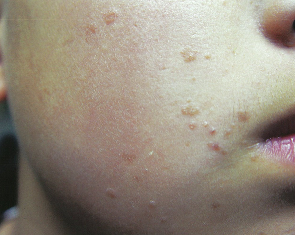 Smooth Skin with Laser Treatment for Flat Warts That Cause Skin Bumps image 3