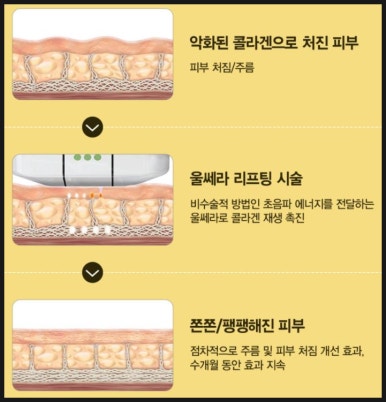 [닥터벨뷰 칼럼 86.]울쎄라(HIFU), 써마지(RF), 그리고 벨뷰에 새로 도입된 온다 리프팅 비교 관련 이미지 4