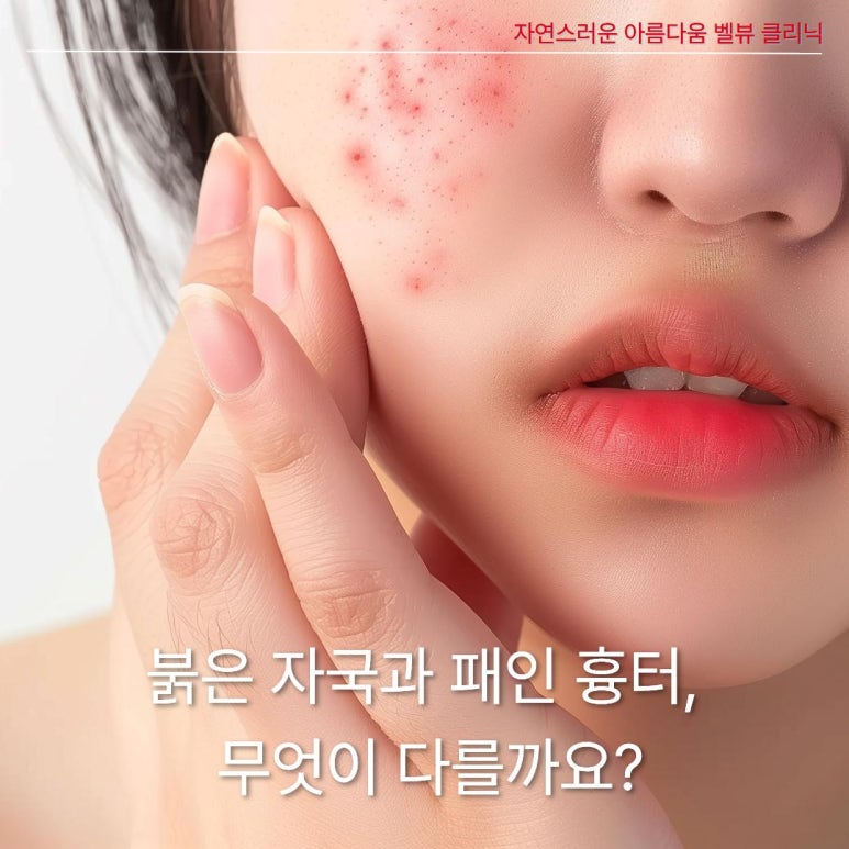 여드름 붉은 자국에 프락셀? 오히려 독이 되는 이유와 올바른 치료법 관련 이미지 2