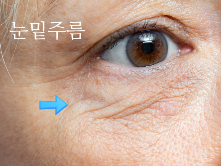 [Dr. Bellevue Column 105.] Crow’s Feet & Under-Eye Wrinkles Have Different Causes, So Why Receive the Same Treatment? (A Complete Comparison of Botox vs. Eye Thermage vs. Rejuran i) image 4