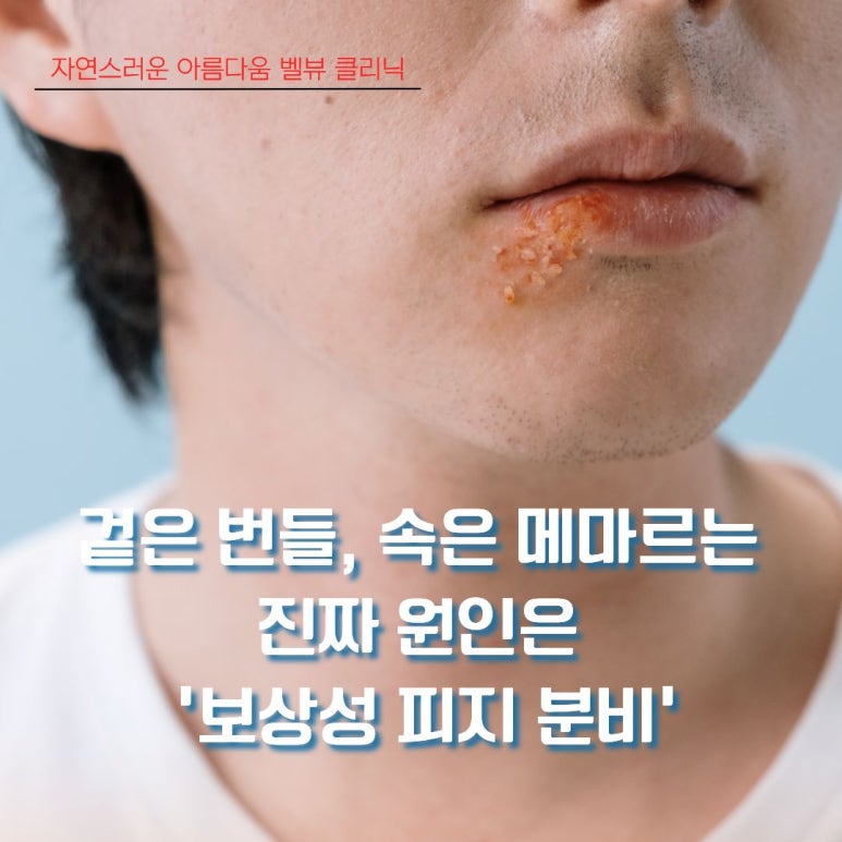 [Dr. Bellevue Column 106.] Oily on the Outside, Dry on the Inside? Get Seborrheic Dermatitis Under Control with This image 2