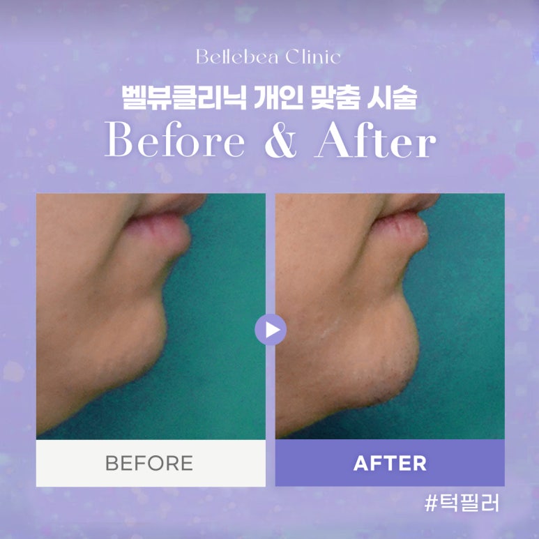 강남역피부과 턱필러전후사진 턱필러후기 관련 이미지 1