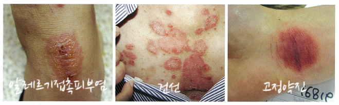 동전모양습진, 화폐상습진(Nummular eczema) 알아보기 관련 이미지 7