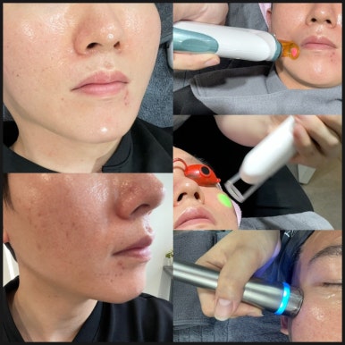 엑셀V 레이저로 실핏줄 혈관없애고 깨끗하고 맑은 피부 톤 찾기 관련 이미지 7