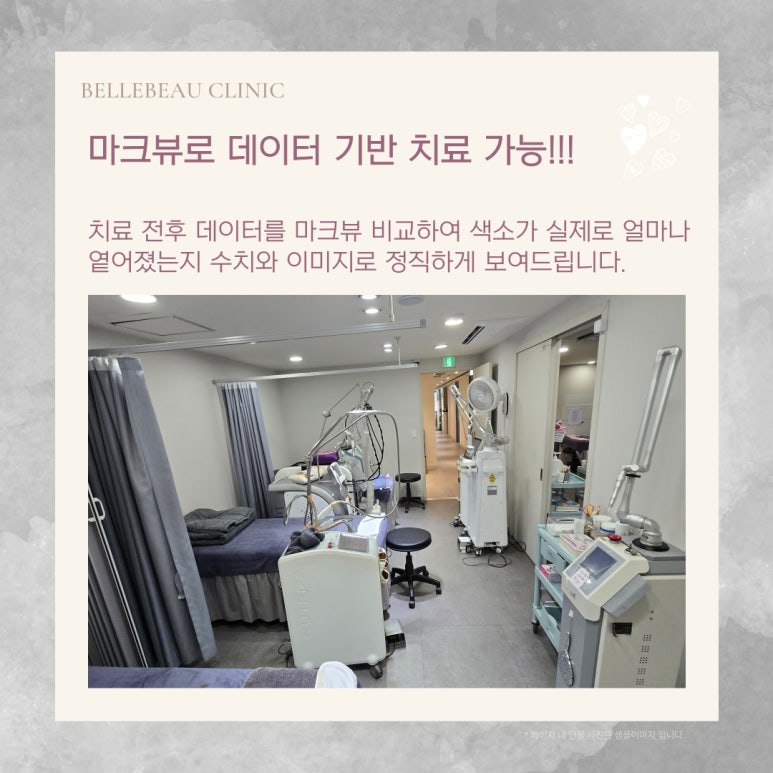 얼굴 실핏줄 만성 홍조 치료, 혈관 문제는 엑셀브이가 정답 관련 이미지 5