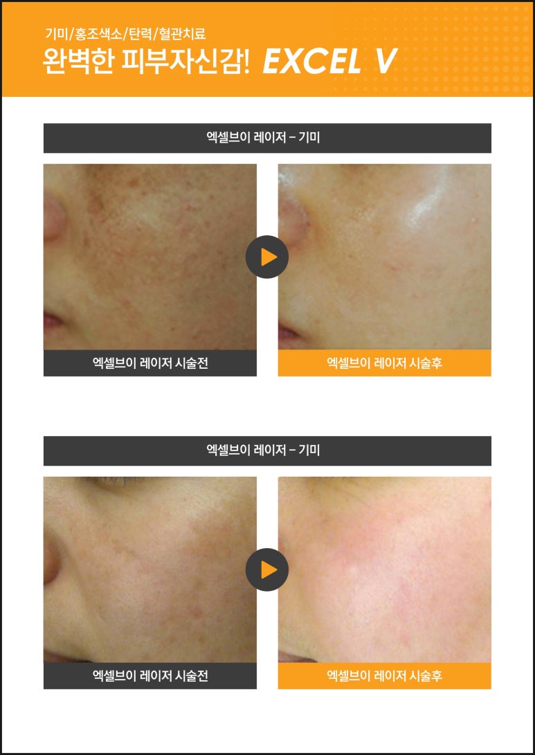 Luxury Laser Excel V: Removing Vessels and Pigment with Three Modes image 6